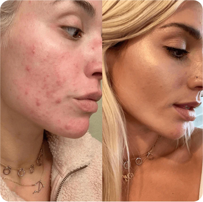  before and after clearstem skincare