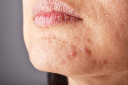 What is Acne and What Causes it?