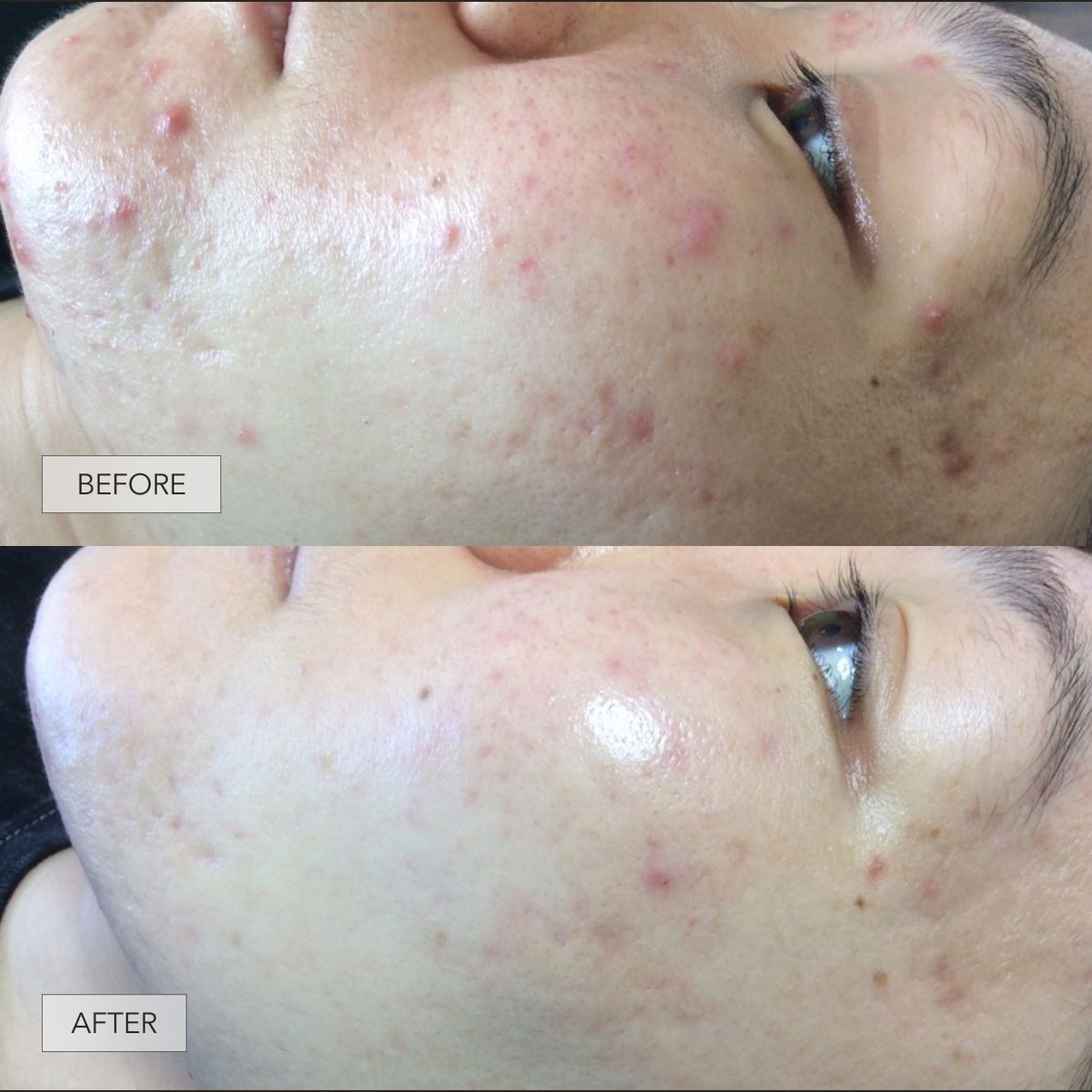 Skin Ripping Transformation Skin Transformation: How Lynn Cleared Her Acne and Dark Spots with CLE
