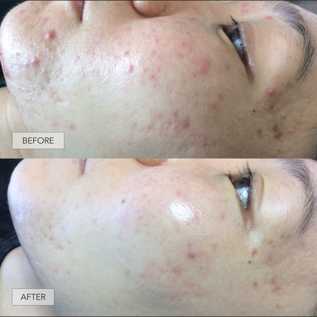 Skin Transformation: How Lynn Cleared Her Acne and Dark Spots with CLEARSTEM