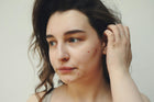 Gut and Acne