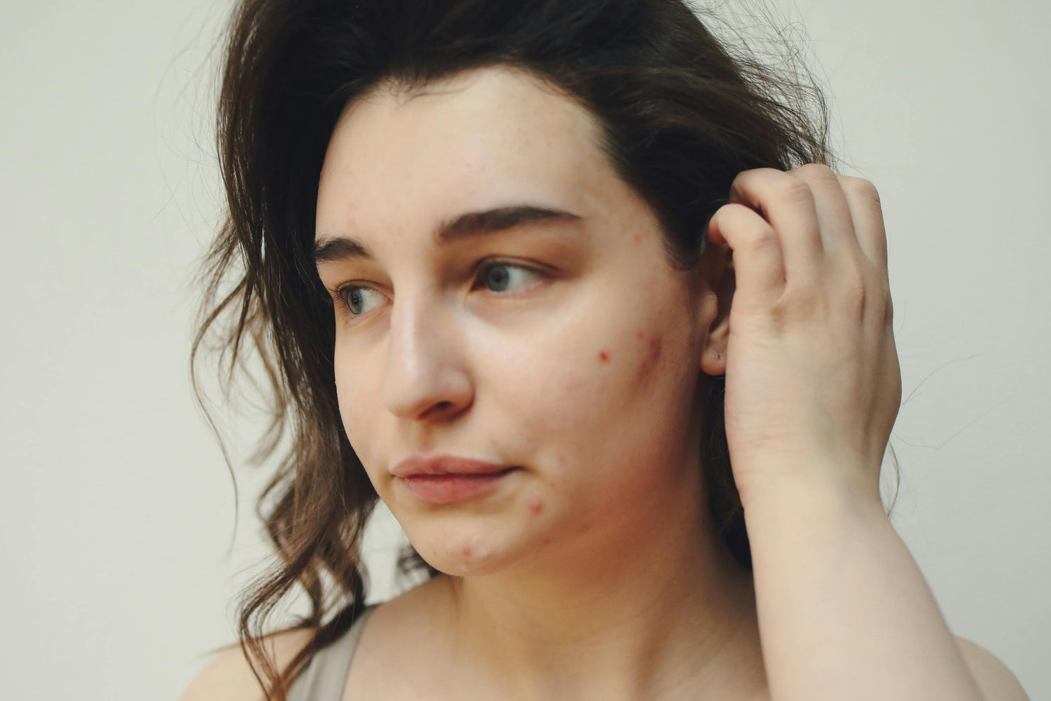 Gut and Acne
