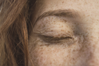 Best Treatment for Hyperpigmentation