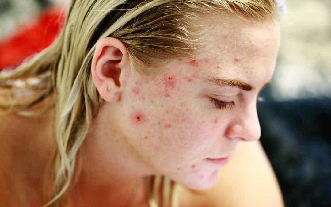 The Four Leading Causes of Acne