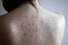 Get Rid of Back Acne & Scars Naturally