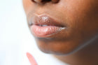 Acne Around the Mouth & Chin