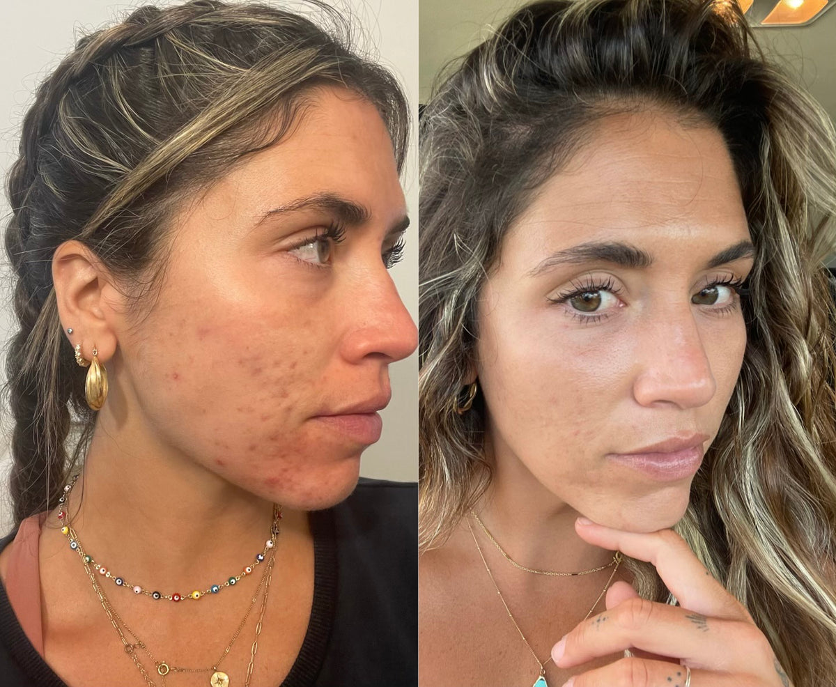 before and after clearstem skincare