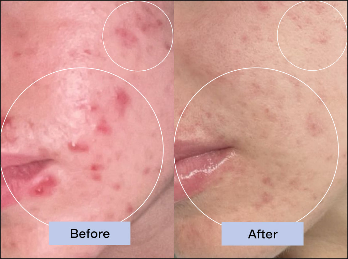 Visible skin results in 7 to 10 days